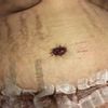 Experiencia de abdominoplastia y duda