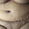 Experiencia de abdominoplastia y duda