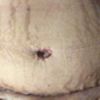 Experiencia de abdominoplastia y duda