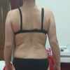 Liposucción sin resultados?