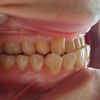Duda sobre resultado final ortodoncia