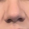 Rinoplastia- nariz muy ancha casi 5 meses depues