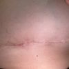 Bulto duro debajo de una cicatriz de puntos de sutura