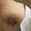 Necrosi areola. Camara hiperbárica