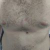 Problemas implante 3D pectus excavatum