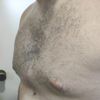 Problemas implante 3D pectus excavatum