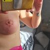 Mastopexia y enrojesimiento en la mitad de los senos