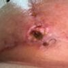 infeccion en costra caida, un mes post mastopexia