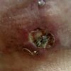 infeccion en costra caida, un mes post mastopexia