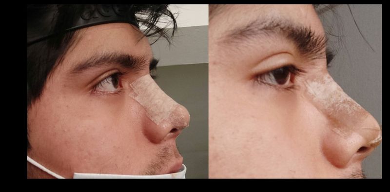 Rinoplastia secundaria por fibrosis , CarlosMinaya, abr 2021