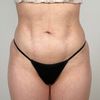 Lesiones por liposucción