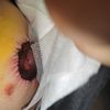 Mastopexia a los 7 días pezon