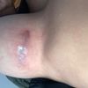 Seroma pecho derecho