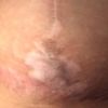 Cicatriz mastopexia 