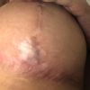 Cicatriz mastopexia 