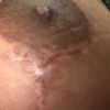 Cicatriz mastopexia 