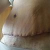 Es normal esto en una abdominoplastia