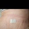 Es normal esto en una abdominoplastia