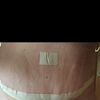Es normal esto en una abdominoplastia
