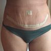 Es normal esto en una abdominoplastia