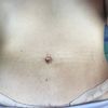 Es normal esto en una abdominoplastia