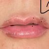 Ácido hialurónico labios muy finos irregularidad