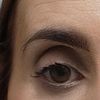 Edema en los ojos después de sesión de carboxiterapia