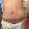 Evolución ombligo abdominoplastia