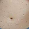 Marcas después de mesoterapia