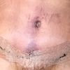 no me puedo enderezar por la abdominoplastía
