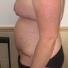 Puntos sueltos abdominoplastia