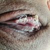 Mala suturas labioplastia???