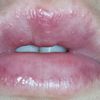 Ácido hialuronico aumento de labios+ picor+ granitos