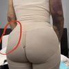 Decepción en Lipotransferencia