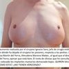 Mamoplastia de aumento erronea por Clinica Martin del Yerro - Amselem