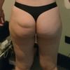Lipofilling para corregir gluteo deformado por caida 