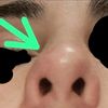 Hondidura punta nariz tras rinoplastia