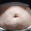 Mi abdominoplastia,operada el 9 de septiembre