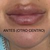 Me han arreglado el destrozo de los labios!!