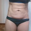 Mini abdominoplastia