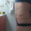 Mini abdominoplastia