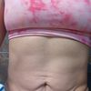 Mini abdominoplastia
