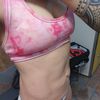 Mini abdominoplastia