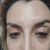 Tratamiento ojeras mal hecho