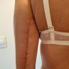 Operación de braquioplastia