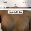 Horrible sensación de frustración aumento de pecho