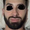 Resultado pésimo frontal rinoplastia