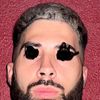 Resultado pésimo frontal rinoplastia