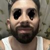Resultado pésimo frontal rinoplastia