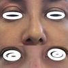 Perito cirugía estética, rinoplastia